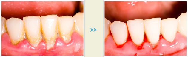 歯石除去の症例